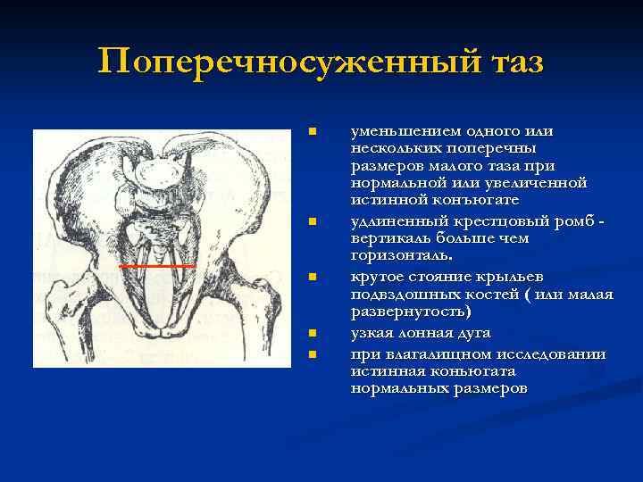 Поперечносуженный таз n n n уменьшением одного или нескольких поперечны размеров малого таза при