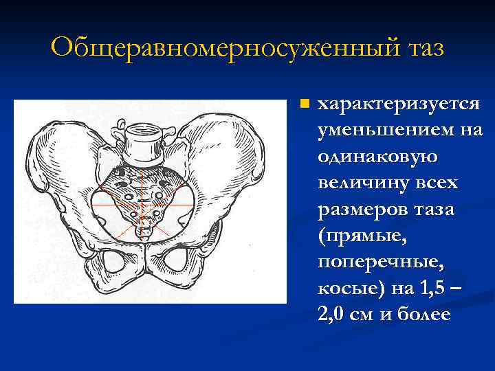 Общеравномерносуженный таз n характеризуется уменьшением на одинаковую величину всех размеров таза (прямые, поперечные, косые)