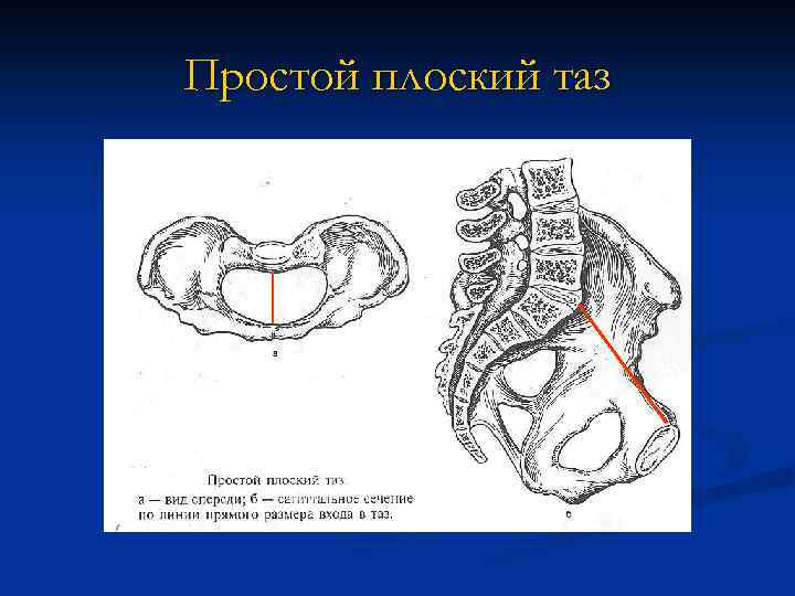 Простой плоский таз 