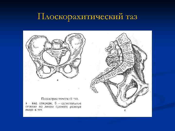 Плоскорахитический таз 