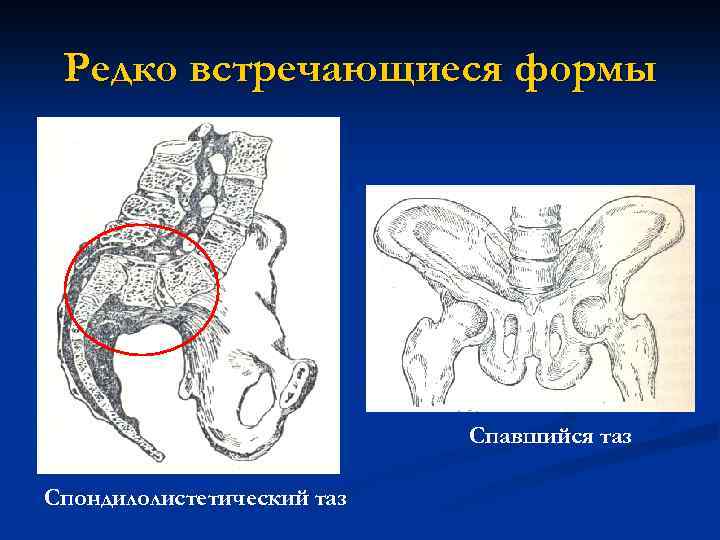 Редко встречающиеся формы Спавшийся таз Спондилолистетический таз 