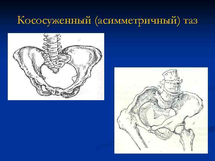 Кососуженный (асимметричный) таз 