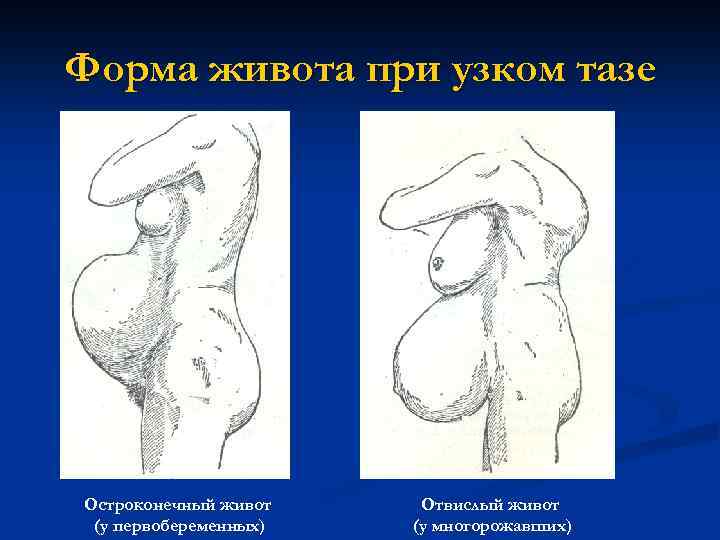 Форма живота при узком тазе Остроконечный живот (у первобеременных) Отвислый живот (у многорожавших) 