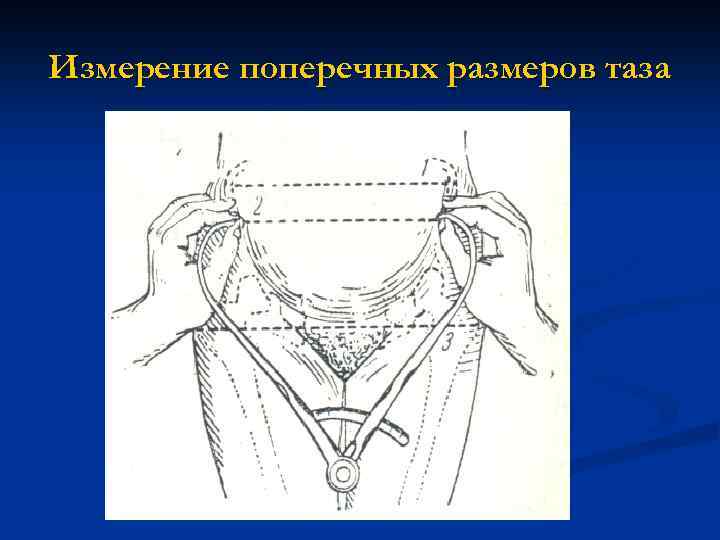 Измерение поперечных размеров таза 