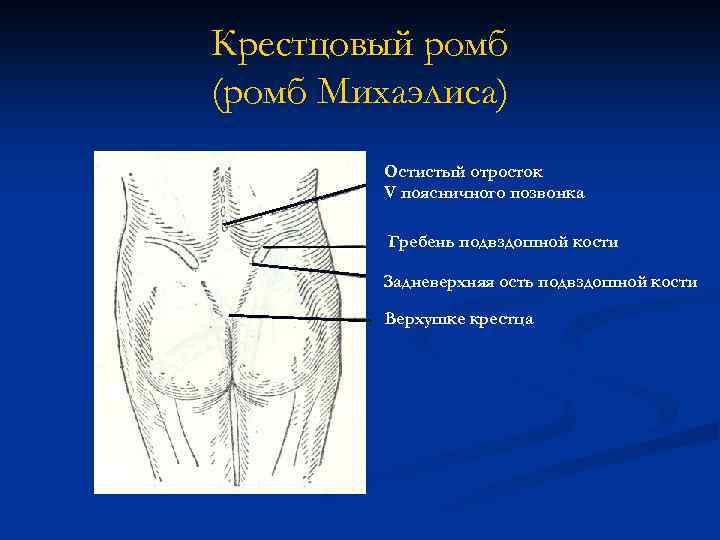 Крестцовый ромб (ромб Михаэлиса) Остистый отросток V поясничного позвонка Гребень подвздошной кости Задневерхняя ость