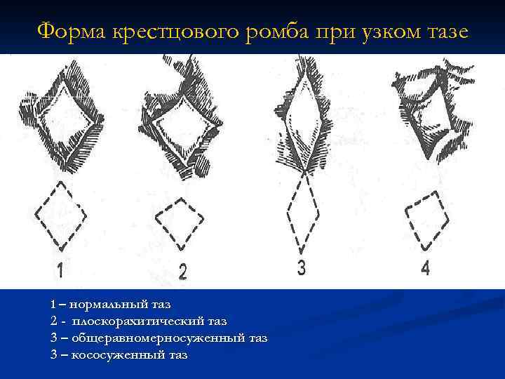 Форма крестцового ромба при узком тазе 1 – нормальный таз 2 - плоскорахитический таз