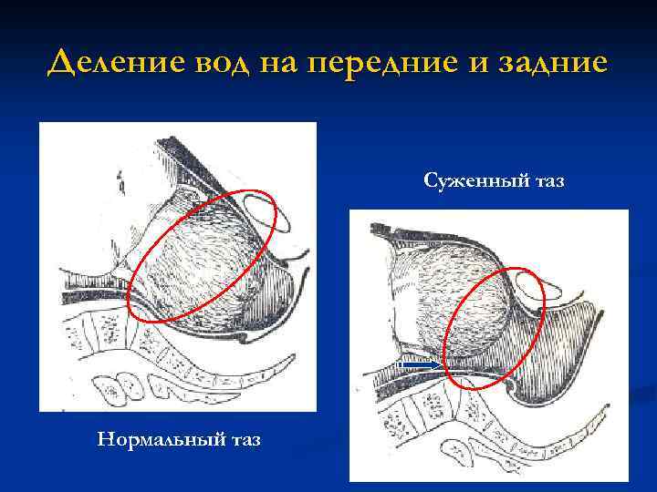 Деление вод на передние и задние Суженный таз Нормальный таз 