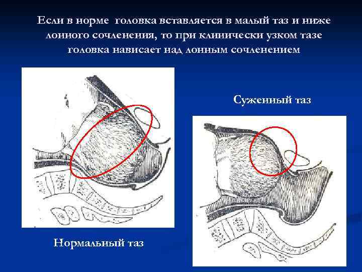 Если в норме головка вставляется в малый таз и ниже лонного сочленения, то при