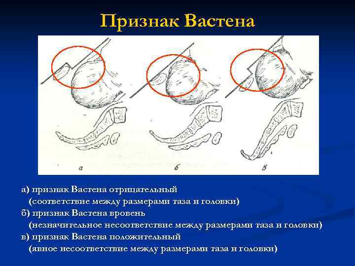 Признак Вастена а) признак Вастена отрицательный (соответствие между размерами таза и головки) б) признак