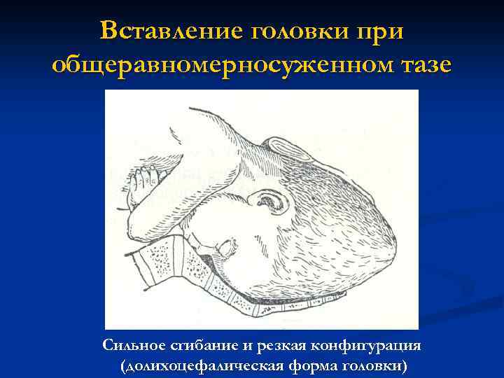 Вставление головки при общеравномерносуженном тазе Сильное сгибание и резкая конфигурация (долихоцефалическая форма головки) головки