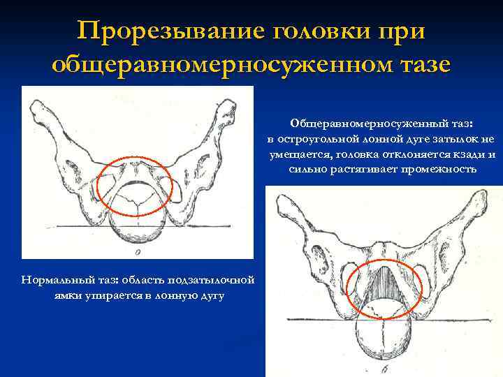 Прорезывание головки при общеравномерносуженном тазе Общеравномерносуженный таз: в остроугольной лонной дуге затылок не умещается,