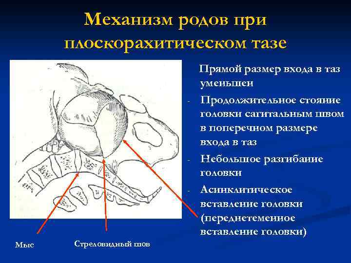 Механизм родов при плоскорахитическом тазе - - - Мыс Стреловидный шов Прямой размер входа