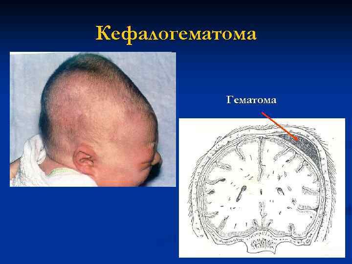 Кефалогематома Гематома 