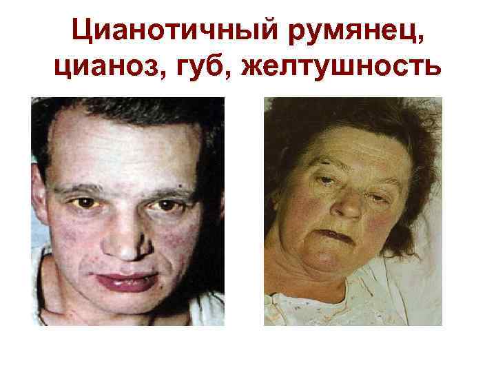 Цианотичный румянец, цианоз, губ, желтушность 