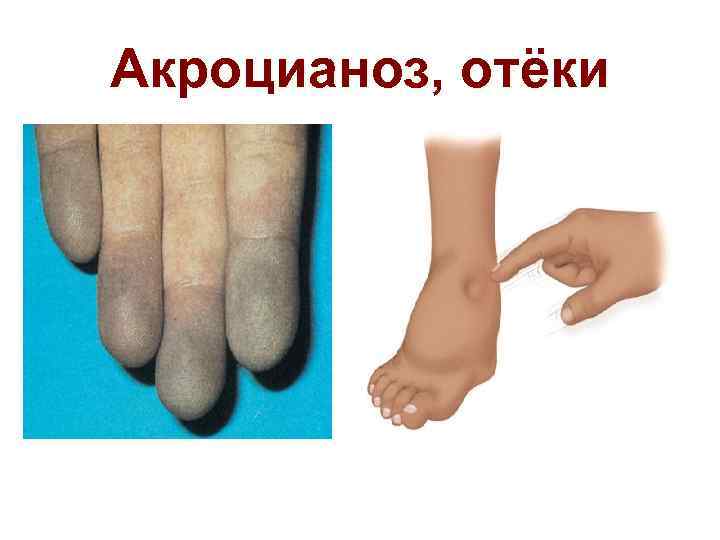 Акроцианоз, отёки 