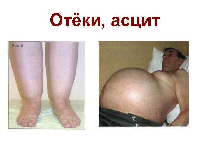 Отёки, асцит 