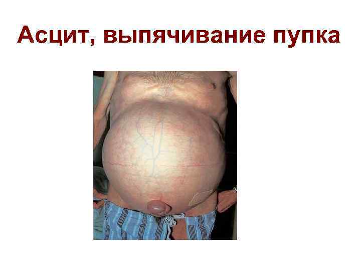 Асцит, выпячивание пупка 