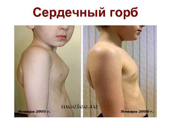 Сердечный горб 