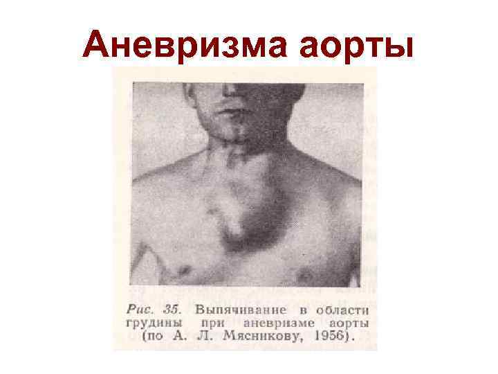 Аневризма аорты 