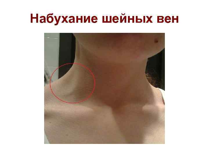 Набухание шейных вен 