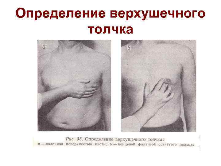 Определение верхушечного толчка 