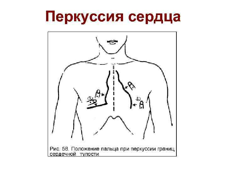 Перкуссия сердца 