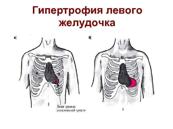 Гипертрофия левого желудочка 