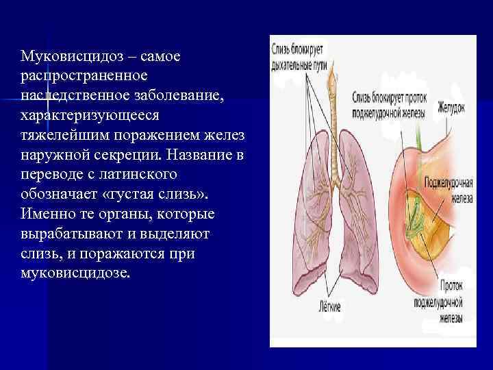 Муковисцидоз – самое распространенное наследственное заболевание, характеризующееся тяжелейшим поражением желез наружной секреции. Название в