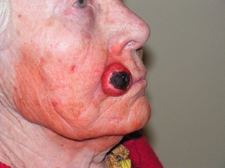 Рак кожи 