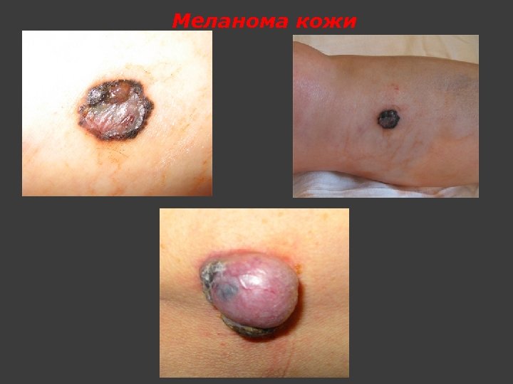 Меланома кожи 