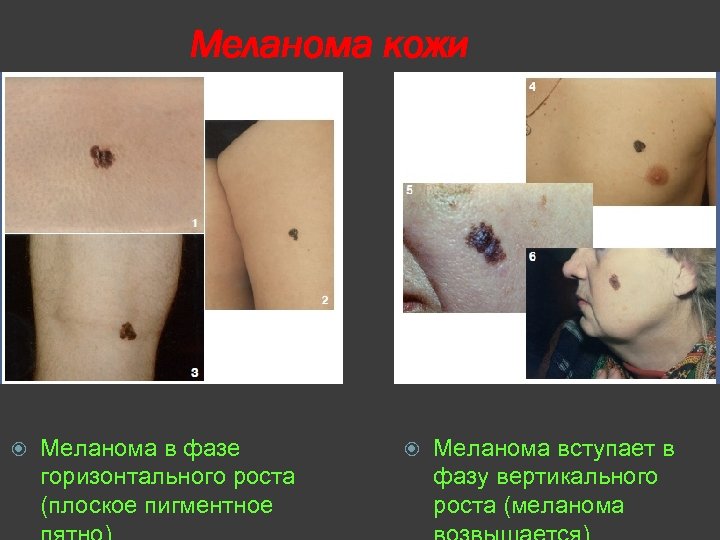 Меланома кожи Меланома в фазе горизонтального роста (плоское пигментное Меланома вступает в фазу вертикального