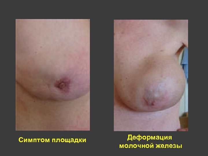Симптом площадки Деформация молочной железы 