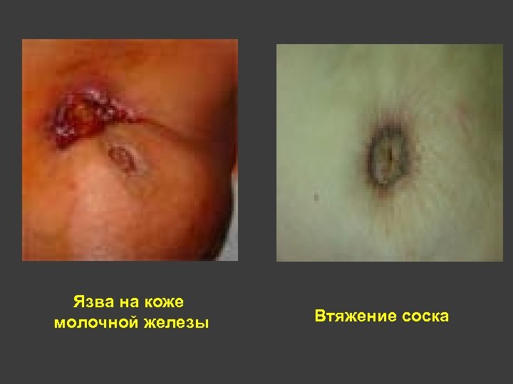 Язва на коже молочной железы Втяжение соска 