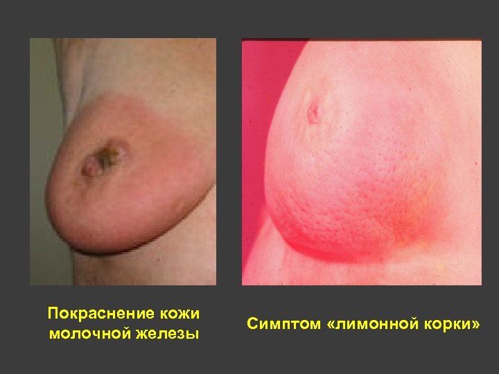 Покраснение кожи молочной железы Симптом «лимонной корки» 