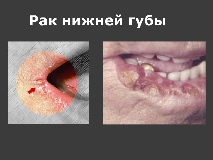 Рак нижней губы 
