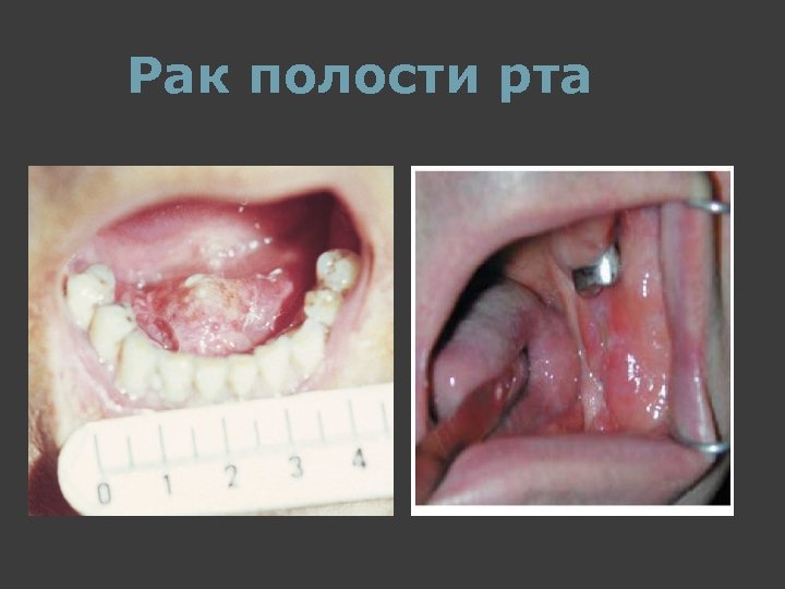 Рак полости рта 