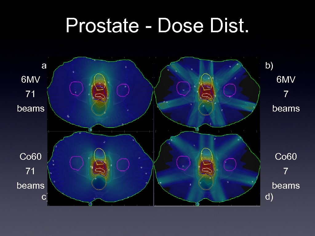Prostate - Dose Dist. a) b) 6 MV 71 7 beams Co 60 71