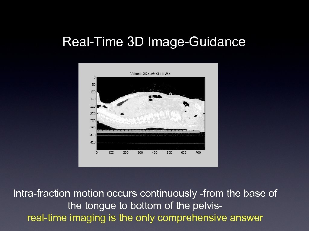Real-Time 3 D Image-Guidance Intra-fraction motion occurs continuously -from the base of the tongue
