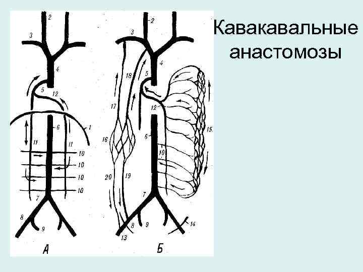 Кавакавальные анастомозы 