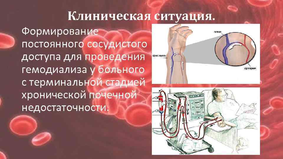 Клиническая ситуация. Формирование постоянного сосудистого доступа для проведения гемодиализа у больного с терминальной стадией