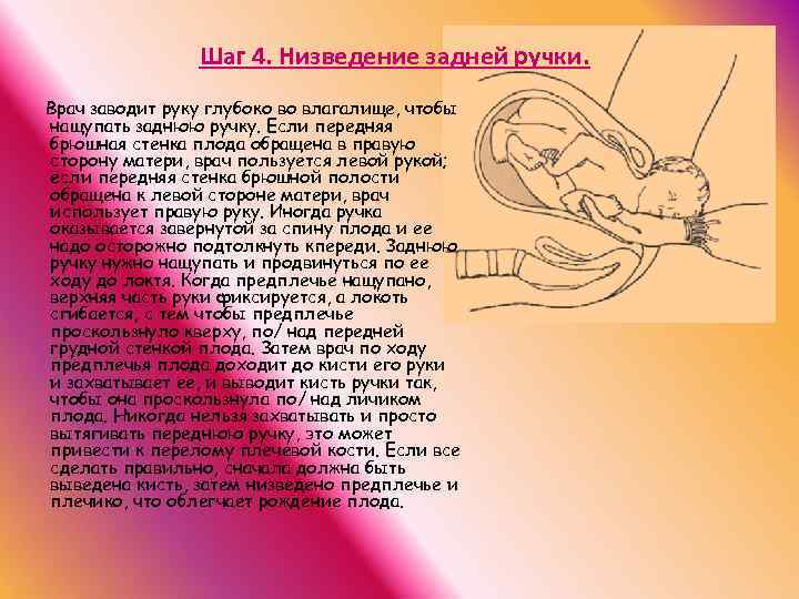 Шаг 4. Низведение задней ручки. Врач заводит руку глубоко во влагалище, чтобы нащупать заднюю