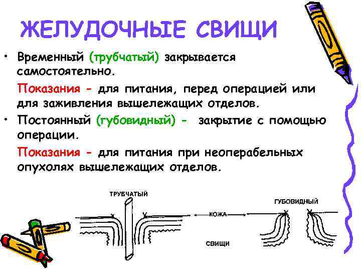 ЖЕЛУДОЧНЫЕ СВИЩИ • Временный (трубчатый) закрывается самостоятельно. Показания - для питания, перед операцией или