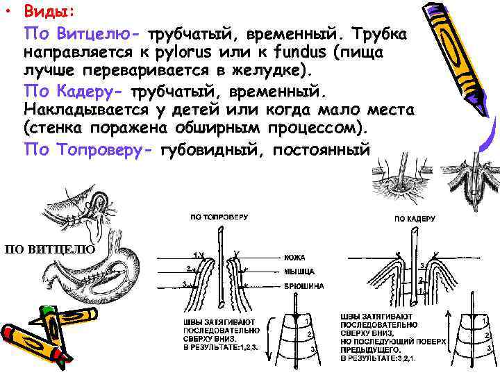  • Виды: По Витцелю- трубчатый, временный. Трубка направляется к pylorus или к fundus