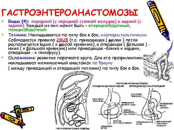 ГАСТРОЭНТЕРОАНАСТОМОЗЫ • • • Виды (4): передний (с передней стенкой желудка) и задний (с