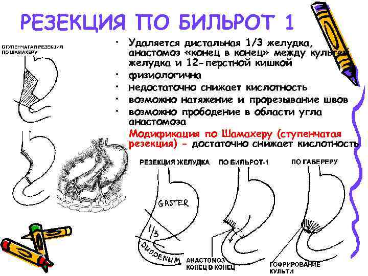 РЕЗЕКЦИЯ ПО БИЛЬРОТ 1 • Удаляется дистальная 1/3 желудка, анастомоз «конец в конец» между