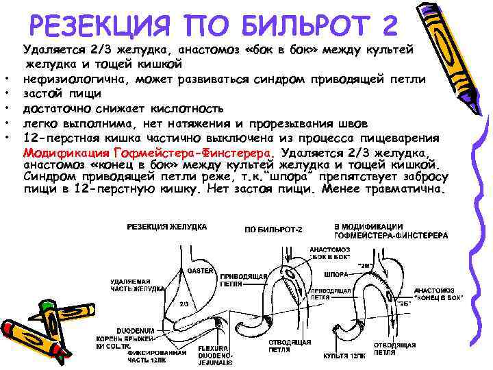 РЕЗЕКЦИЯ ПО БИЛЬРОТ 2 • • • Удаляется 2/3 желудка, анастомоз «бок в бок»