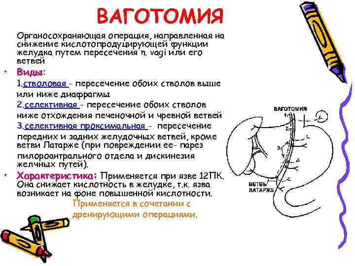 ВАГОТОМИЯ Органосохраняющая операция, направленная на снижение кислотопродуцирующей функции желудка путем пересечения n. vagi или