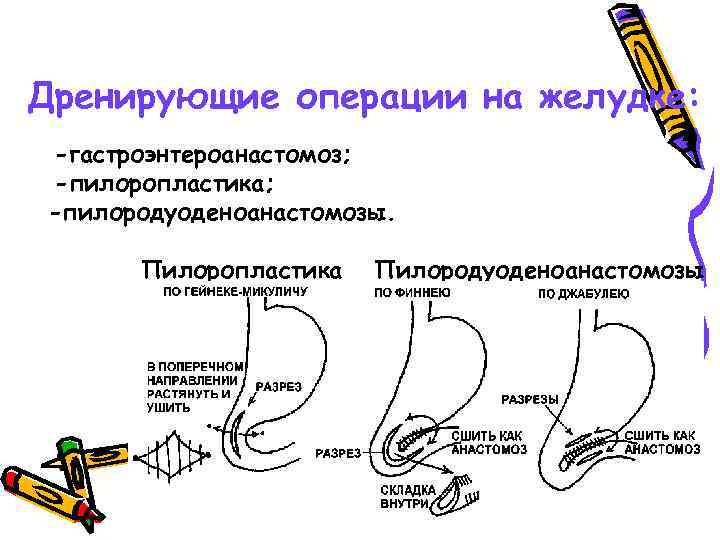 Дренирующие операции на желудке: -гастроэнтероанастомоз; -пилоропластика; -пилородуоденоанастомозы. Пилоропластика Пилородуоденоанастомозы 