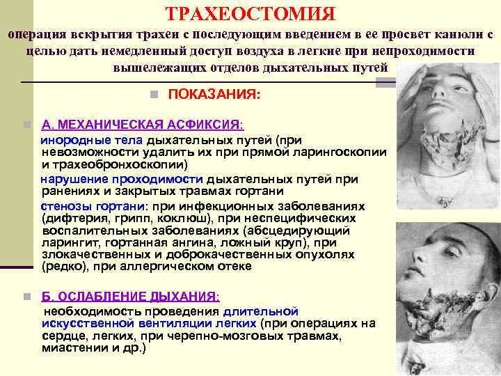 ТРАХЕОСТОМИЯ операция вскрытия трахеи с последующим введением в ее просвет канюли с целью дать