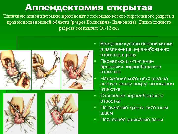 Аппендектомия открытая Типичную аппендектомию производят с помощью косого переменного разреза в правой подвздошной области